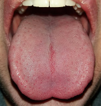 Featured image of post Smoking Tongue Cancer You can get tongue cancer even if you ve never smoked