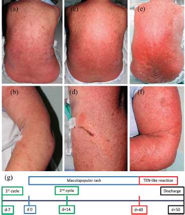 lung cancer that has spread to liver and lymph nodes