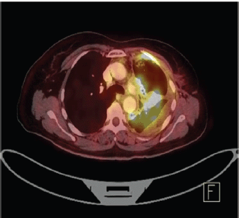 epithelioid malignant mesothelioma life expectancy