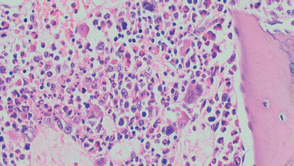 T Lymphoblastic Lymphoma With r Abl Negative Chronic Myeloid Leukaemia A Novel Association Ecancer