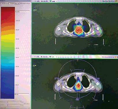 Optimising Craniospinal Irradiation For Medulloblastoma A Dosimetric Optimising Craniospinal Irradiation For Medulloblastoma A Dosimetric