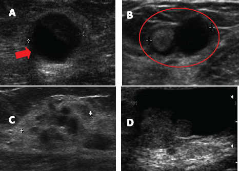 ductalis papilloma usg papillomatosis tüdő röntgen