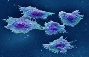 tasa de supervivencia promedio para el cáncer de próstata