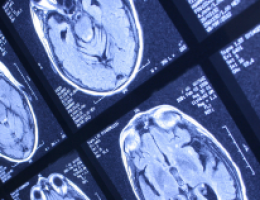 New immunotherapy target discovered for malignant brain tumours