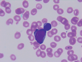 Acute myeloid leukaemia presenting as acute liver failure—a case report ...