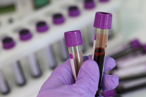 hombres en riesgo de cáncer de próstata