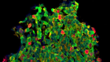 Detección del cáncer de próstata y resultados del tratamiento de una sola institución Detección del cáncer de próstata y resultados del tratamiento de una sola institución