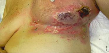 Acute radiation dermatitis in breast cancer: topical therapy with vitamin E  acetate in lipophilic gel base - ecancer