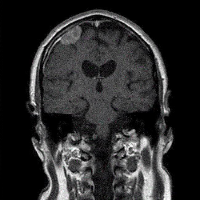 Metastasis From Glioblastoma Multiforme A Metaanalysis