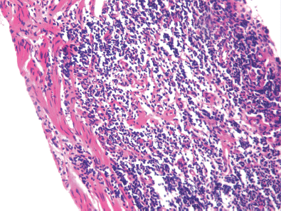 Rhabdomyosarcoma of prostate presenting as bladder outlet obstruction ...