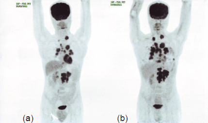 Forty-nine-month survival in a metastatic renal cell carcinoma patient ...