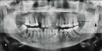 Oral and maxillofacial considerations in Gardner’s syndrome: a report ...