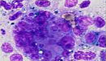 Las células tumorales de los pacientes con cáncer cerebral se expanden por la sangre del cuerpo
